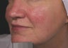 Vein treatment