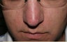 Vein treatment