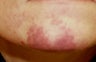 Vascular malformations or birthmarks