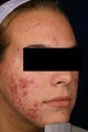 Acne laser treatment with PDT