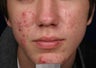 Acne laser treatment with PDT