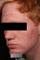 Acne laser treatment with photodynamic therapy