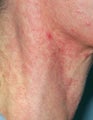 Vbeam laser treatment