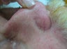 Vbeam for veins on nose