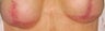 Breast implant scar removal