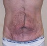 VASER Shape to Abdomen