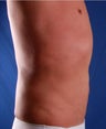 VASER Shape to Abdomen