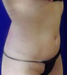 VASER Shape to Abdomen