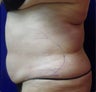 VASER Shape to Abdomen