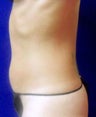 VASER Shape to Abdomen