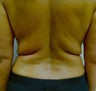 VASER Shape to Back