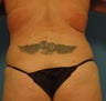 VASER Shape to Back
