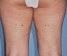 VASER Shape to Legs