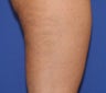 VASER Shape to Legs