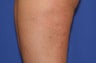 VASER Shape to Legs