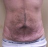 VASER Shape to Abdomen