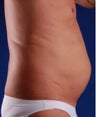VASER Shape to Abdomen