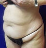 VASER Shape to Abdomen