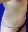 VASER Shape to Abdomen