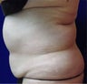 VASER Shape to Abdomen