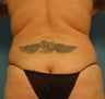 VASER Shape to Back