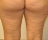 VASER Shape to Legs