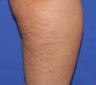 VASER Shape to Legs