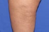 VASER Shape to Legs