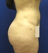 VASER Liposelection