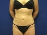 VASER Liposelection