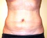 Ultrasonic assisted (VASER) Liposuction
