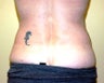 Ultrasonic assisted (Vaser) Liposuction of Flanks