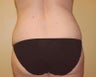 Vaser Liposuction