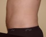 Male Liposuction - Abdomen