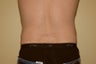 Male liposuction - flank