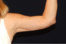 Liposuction