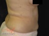 Vaser Lipo - Abdomen