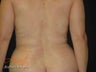 Vaser Lipo - Flanks