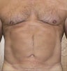 VASER liposuction of abdominal wall