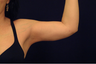 Liposuction
