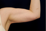 Liposuction