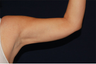 Liposuction