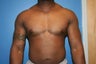VASER Liposuction for gynecomastia