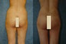 VASER Liposuction