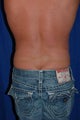 45 year-old male- liposuction of flanks