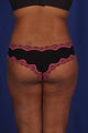 26 year-old woman- liposuction of flanks