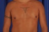 31 year-old male with gynecomastia