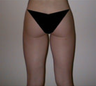 Liposuction