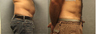 Vaser Liposelection