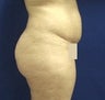 VASER Liposelection